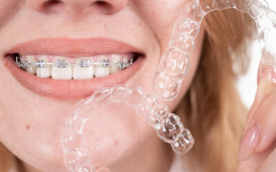Brackets o Invisalign: diferencias, ventajas y cómo saber cuál te conviene