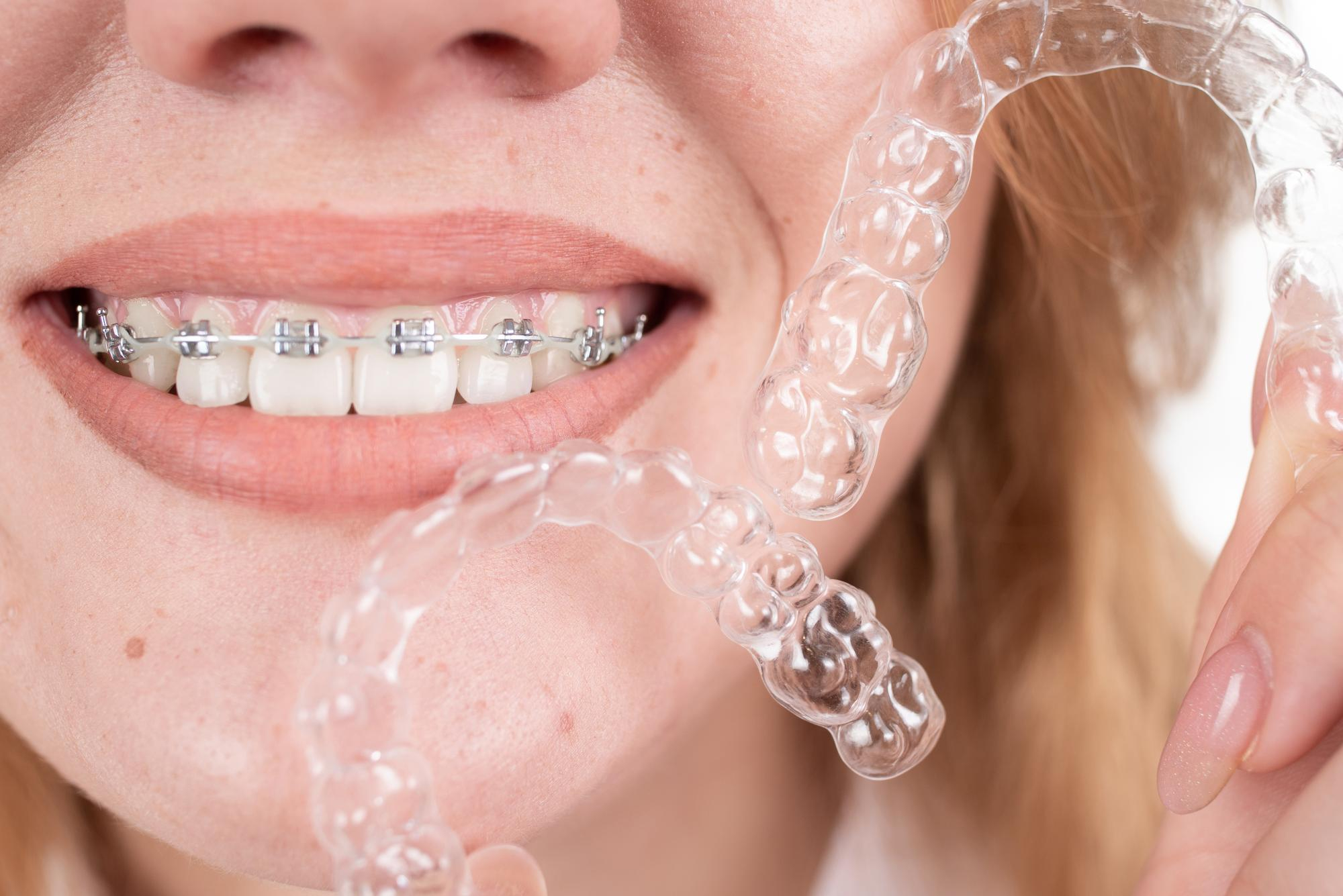 brackets o invisalign blog